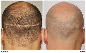 Patient Ssp A Complete Strip Scar Camouflage Forhair Dr Cole Hair Transplant Hairsite Hai Hair Loss Medication Hair Loss Female Hair Loss Solutions