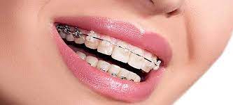 Dentes Tortos Encavalados Apinhados Como Corrigir Tratar