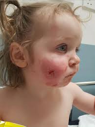 Shocking pictures of toddler left scarred for life after bite attack at  Leeds soft play centre