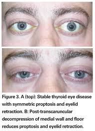 Lid lag refers to a delay in the descent of the upper eyelid in relation to the eyeball when looking downward. Update On Thyroid Eye Disease