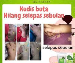 Kudis buta boleh berjangkit dengan sesiapa saja yang berdekatan. Kudis Buta Atau Scabies Mayyababy Cream Shower Gel Facebook