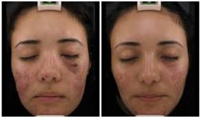 My experience with ipl laser treatment for acne. How To Use Ipl For Melasma Rosacea Dark Spots More Vida