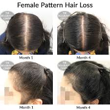 Hair loss treatments for women that work. The Belgravia Hair Loss Centre Results Were Quick To See And Staff Are Very Friendly And Helpful See This Female Pattern Hair Loss Treatment Client S Success Story Here On Belgravia S