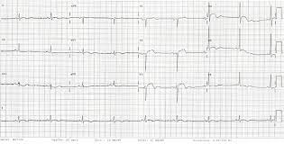 How to interpret the ecg / ekg: Ekg Bei Perikarditis Fokus Ekg