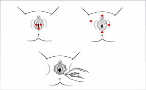 La fel ca si crampele abdominale, vulvodinia este un simptom cu multiple cauze posibile. Vulvodinia Como Saber Si Tengo Clinica De Fisioterapia Yofisio