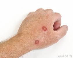 Evidence of increasing age includes wrinkles and sagging skin. What Are The Most Common Causes Of Skin Lesions