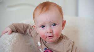 Erfahren sie hier die wichtigsten informationen über neurodermitis. Neurodermitis Baby Erkennen Richtig Behandeln Hallo Eltern