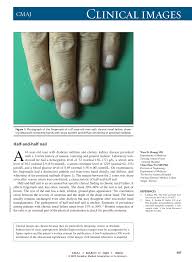Functional or morphological disruption of. Pdf Half And Half Nail