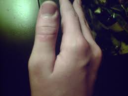 How To Treat A Minor Burn 9 Steps Instructables