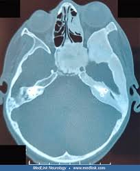 Image result for Otalgia