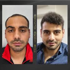 Haartransplantation vor und nach den Ergebnissen