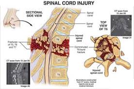Image result for Spinal Trauma