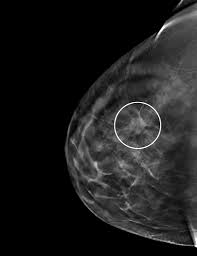 Fibrous and glandular tissue looks white on a mammogram. 3 D Mammography Test Appears To Improve Breast Cancer Detection Rate The New York Times