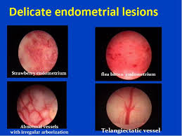 Treatment of endometriosis and laparoscopy. Endoscopic Explanation Of Unexplained Infertility Intechopen