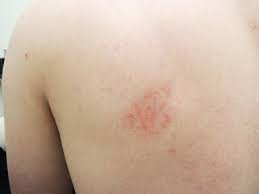 Image result for Lichen Simplex Chronicus