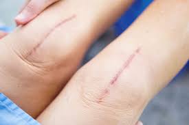 Maybe you would like to learn more about one of these? Healing Your Scabs After Surgery