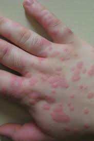 If the hiv rash is the result of antiviral medications, the rash will appear as raised reddish lesions yes, hsv does not protect against hiv. Erythema Multiforme Symptoms Pictures Causes Treatment