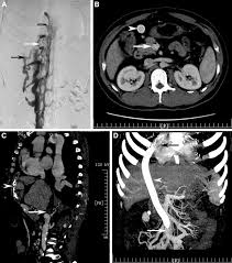 Mesoatrial Shunt For Budd Chiari Syndrome Annals Of Vascular Surgery