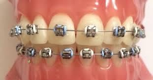 Choose foods such as soups, smoothies, soft boiled rice, yogurt, boiled egg, mashed potatoes, or puddings. Manchester City Themed Elastics Braces Ideas Color Manchester City