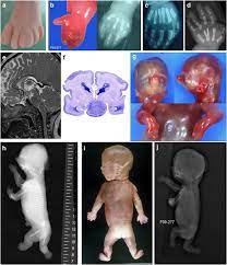 Pallister hall syndrome (phs) new york clients. New Insights Into Genotype Phenotype Correlation For Gli3 Mutations European Journal Of Human Genetics