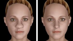 The nose is round with a thick tip called bulbous. Large Nasal Tip Nose Job Rhinoplasty Nose Job Rhinoplasty Nose Jobs Rhinoplasty