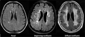 Schilder´s disease is a primary demyelinating disease of childhood and is considered by some to represent childhood multiple sclerosis. White Matter Diseases With Radiologic Pathologic Correlation Radiographics