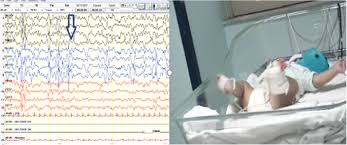 Explore log in sign up. West Syndrome A Comprehensive Review Springerlink