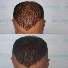 Having an itchy scalp leads to hair loss often because of the underlying condition. Tattoo Hair