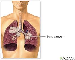 Secondhand smoke (shs) is any smoke not inhaled by a smoker that is instead inhaled by using a fan or opening a window gets rid of the secondhand smoke. Secondhand Smoke And Lung Cancer Medlineplus Medical Encyclopedia Image