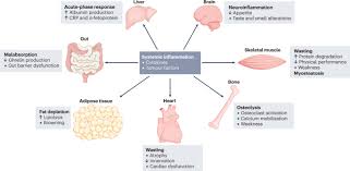 Image result for Cachexia in Cancer