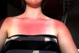 Ist Dieser Sonnenbrand Sehr Schlimm Bild Dabei Sonne