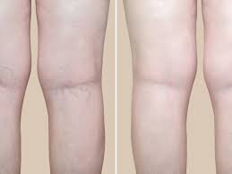 Benefits Of Laser Vein Treatment Core Medical Wellness