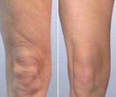 Pin On Skin Tightening