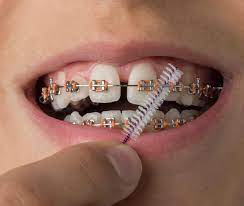 Maybe you would like to learn more about one of these? Best Ways To Keep Your Teeth Clean Healthy While Wearing Braces