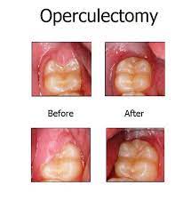 Operculectomy News Dental Hygiene School Dental Procedures Dental