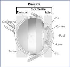 Image result for Uveitis