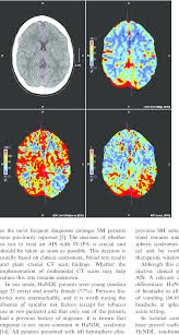 Im jahr 2021 tritt die elfte version des neuen icd in kraft tritt. Perfusion Ct From Patient Number 7 Showing Focal Hypoperfusion In Left Download Scientific Diagram