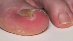Image result for Paronychia feet