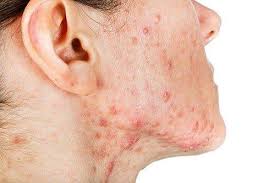Check spelling or type a new query. Cystic Acne Treatment Singapore Advice From A Doctors Perspective