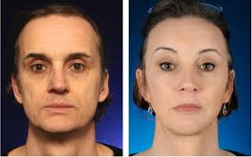 Cheek filler is a safe and convenient way to increase the volume. Facial Feminization Surgery Cheek Augmentation Creating High And Feminine Cheekbones 2pass Clinic