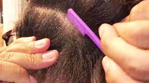 Tectonic flakes montage (magnitude 1.5) | dandruff on scalp | seborrheic derm. Dandruff Scraping Videos Are The New Pimple Popping Videos Self