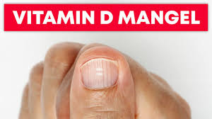 5 Anzeichen Eines Akuten Vitamin D Mangels Youtube