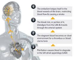 Maybe you would like to learn more about one of these? Cause And Risk Factors Boston Scientific