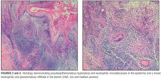 Cutaneous tuberculosis (tb) results from skin infection with mycobacterium tuberculosis (m. Cutaneous Tuberculosis A Practical Case Report And Review For The Dermatologist Jcad The Journal Of Clinical And Aesthetic Dermatology