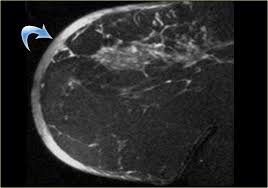 However, mri has demonstrated superiority in the evaluation of breast cancer recurrence in the conserved breast following surgery. The Radiology Assistant Mri Of The Breast