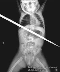 Image result for PECARN Pediatric Intra-Abdominal Injury Algorithm