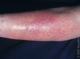Image result for allergy rash on the legs