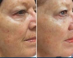 microneedling with prp before and after results faces, AI generated