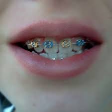 Orange Look Yellow And Blue Braces Braces Colors Getting Braces Braces