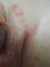Image result for diaper dermatitis